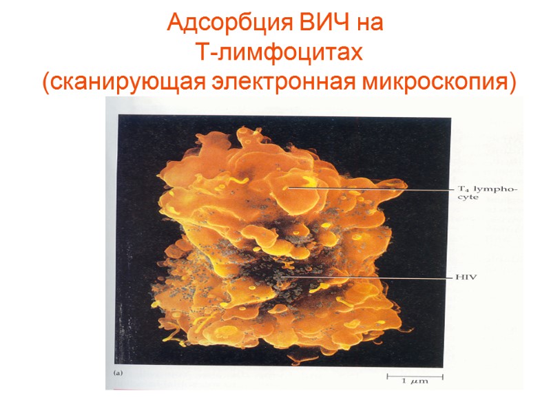 Адсорбция ВИЧ на   Т-лимфоцитах  (сканирующая электронная микроскопия)